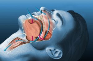 sleep apnea seattle WA