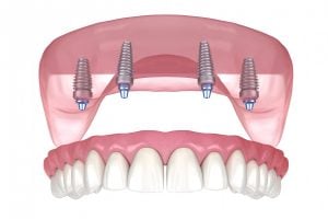 Illustration: all on 4 implant Bellevue WA