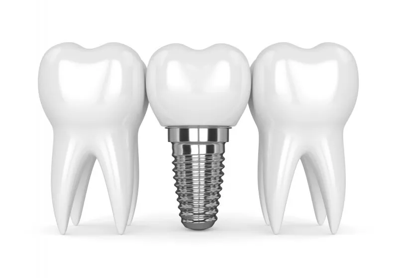 Dental Implants Draft