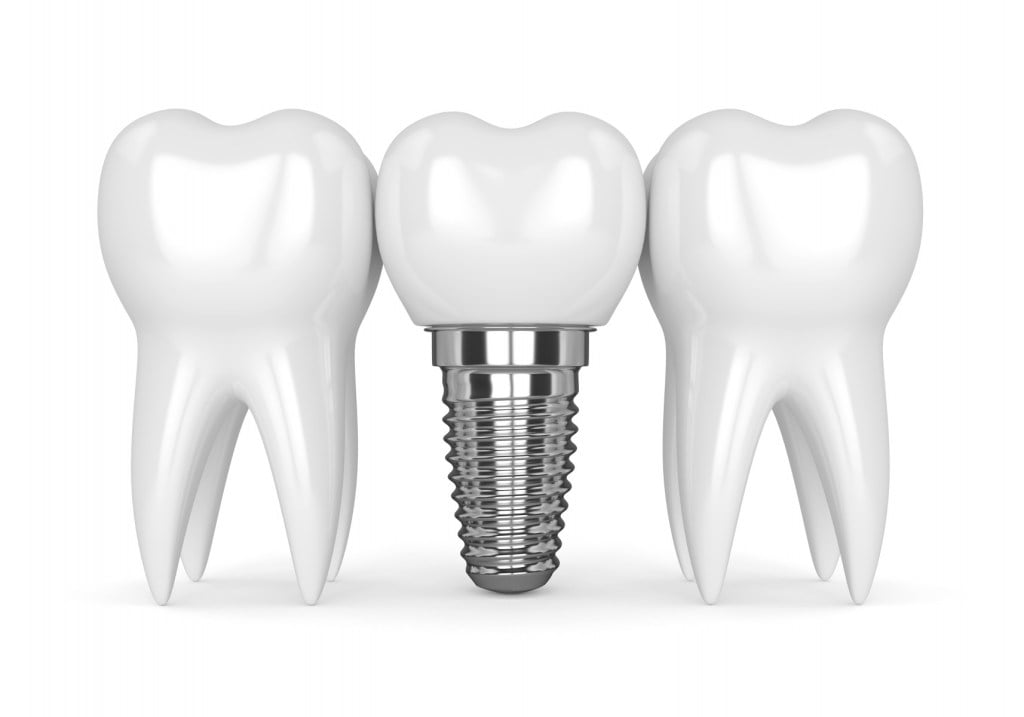 Dental Implants Draft