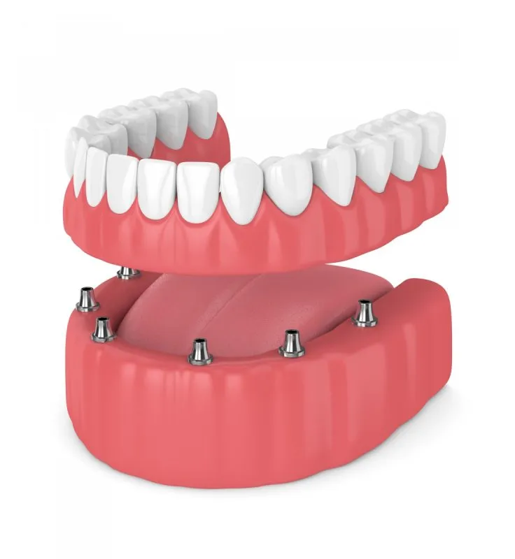 Illustration: Dental Implants illustration