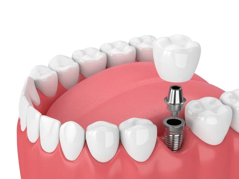Illustration: Dental Implants illustration