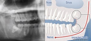 Diagram of impacted teeth